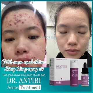 Serum chăm sóc da mụn (Serum Dr Antibi) Dr.Antibi 10ml