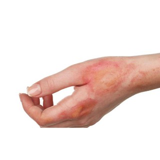 Xịt bỏng Panthenol Xịt Mẫu Mới ✅(Chính Hãng 100%)
