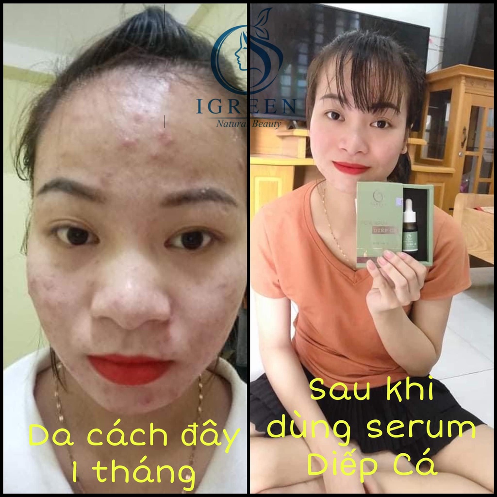 Serum GIẢM MỤN, GIẢM THÂM DIẾP CÁ - Hỗ trợ Se khít lỗ chân lông, sáng đều da, kiềm dầu - FREESHIP | BigBuy360 - bigbuy360.vn
