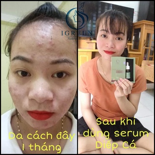 Combo Sạch Mụn, Thâm giúp Da CĂNG BÓNG, MỊN MÀNG IGREEN - IGREEN COMBO
