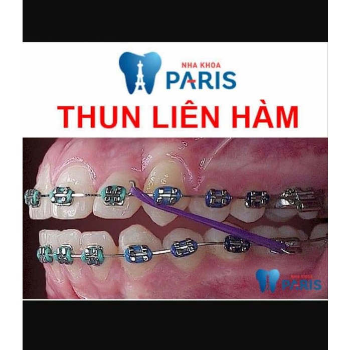 Thun liên hàm nha khoa