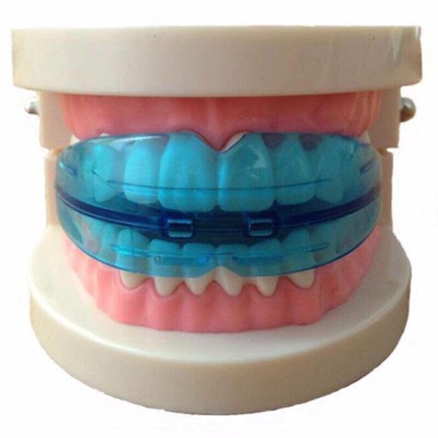 Niềng răng silicon bảo vệ răng ( KTN)