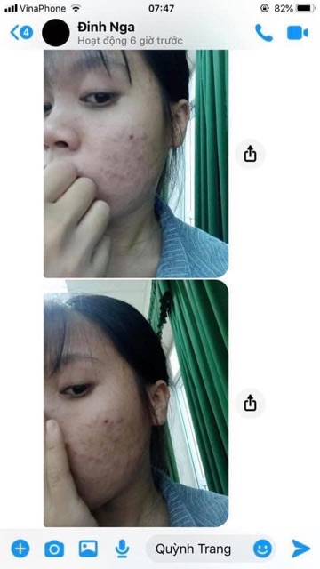 Serum Mụn Lumos Acne | BigBuy360 - bigbuy360.vn