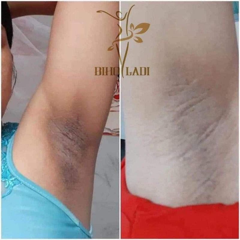 Kem trị thâm 5s ( trị thâm nách, mông, bikini)