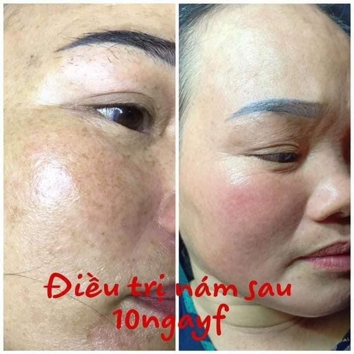 KEM NÁM DOCTOR QUEEN KEM