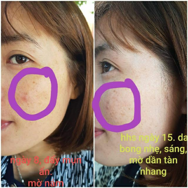 HUYẾT HỒNG SÂM - VUA TRỊ MỤN - TÁI TẠO | BigBuy360 - bigbuy360.vn