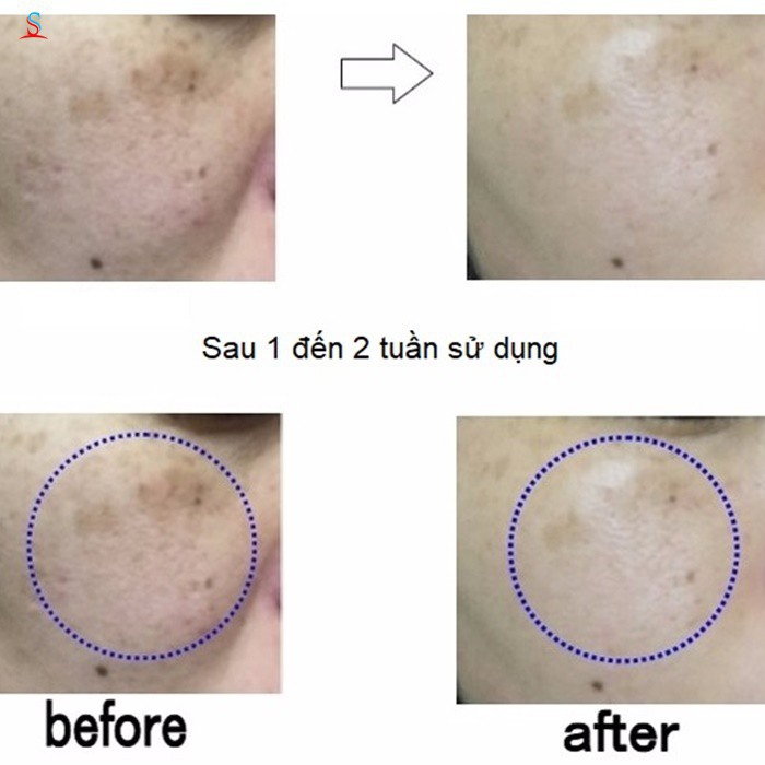 Kem Giảm Nám, Tàn Nhang H2 Hydrogen Skin Care Spot Cream