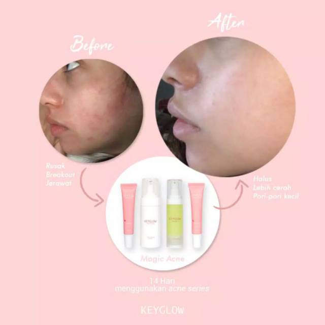 (Hàng Mới Về) Serum Ốc Sên Dưỡng Trắng Da Trị Mụn