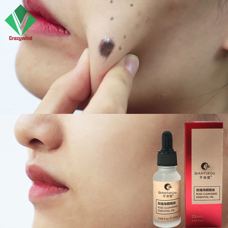 (Hàng Mới Về) Serum Loại Bỏ Nốt Ruồi Và Tàn Nhang Không Đau 20ml