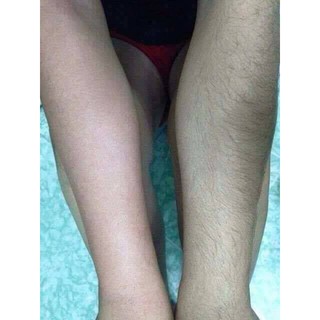 Triệt lông cùng combo wax + mỡ