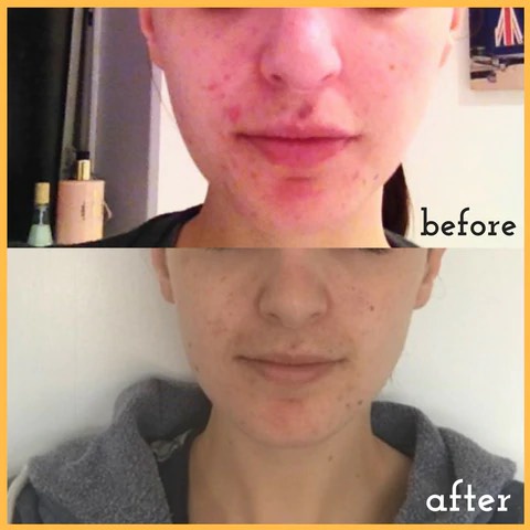 [Hỏa tốc] Gel giảm mụn mờ thâm OXYGEN Blemish Acne Gel 10ml
