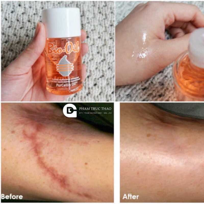 Bi.o oi.l trij rạn da mẹ bầu