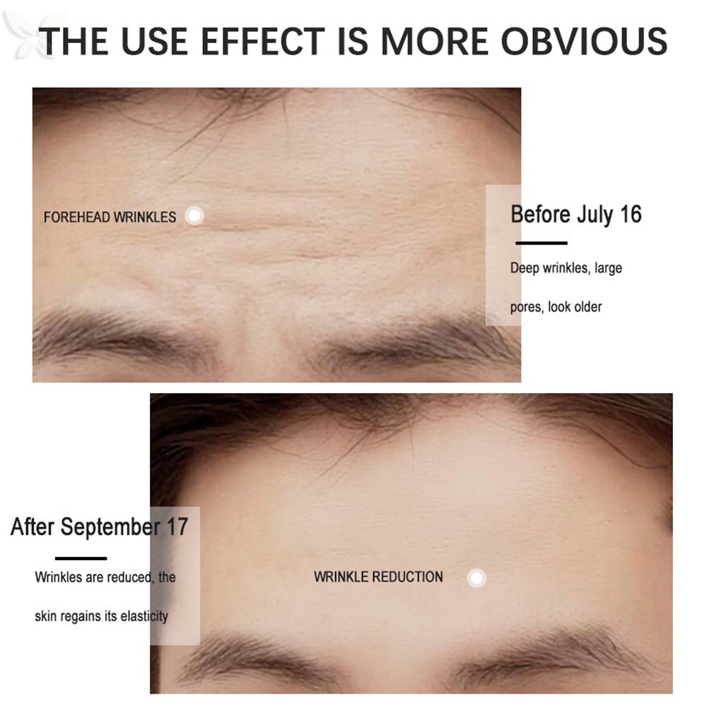 Miếng dán trán chống nhăn dưỡng ẩm cho da chống lão hóa/xóa nếp nhăn/nâng cơ làm săn chắc