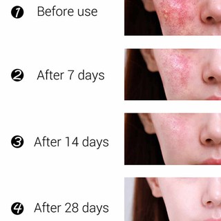 KEM CHUYÊN SÂU DÀNH CHO MỤN BỌC, MỤN THÂM, TRẮNG DA XÓA THÂM, MỜ NÁM