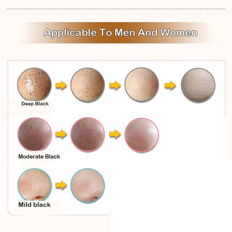Miếng Dán Mũi Làm Mềm Da Lột Mụn Đầu Đen / Mụn Trứng Cá / Đầu Trắng YR