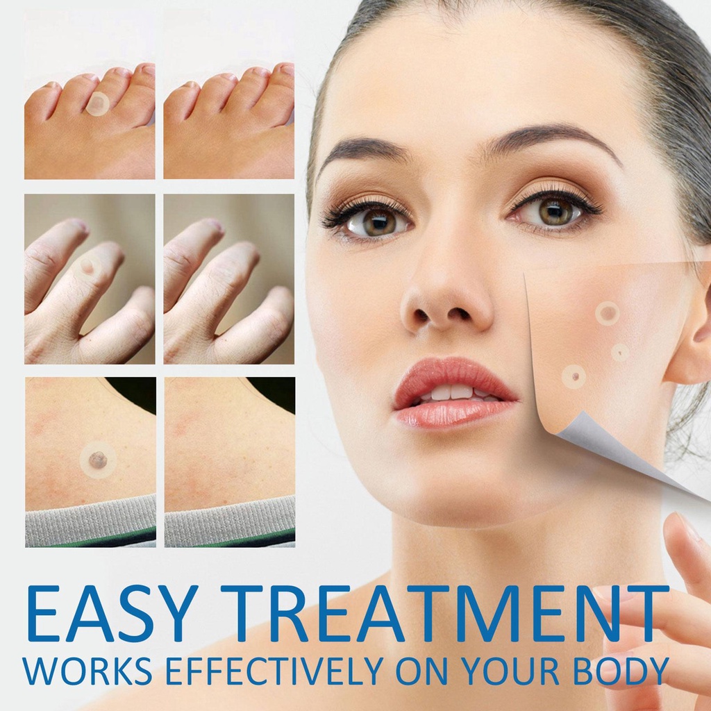 Hộp 180 Miếng Dán Hỗ Trợ Giảm Mụn Tinh Chất Hydrocolloid / Mụn Trứng Cá / Mụn Nhọt Vô Hình