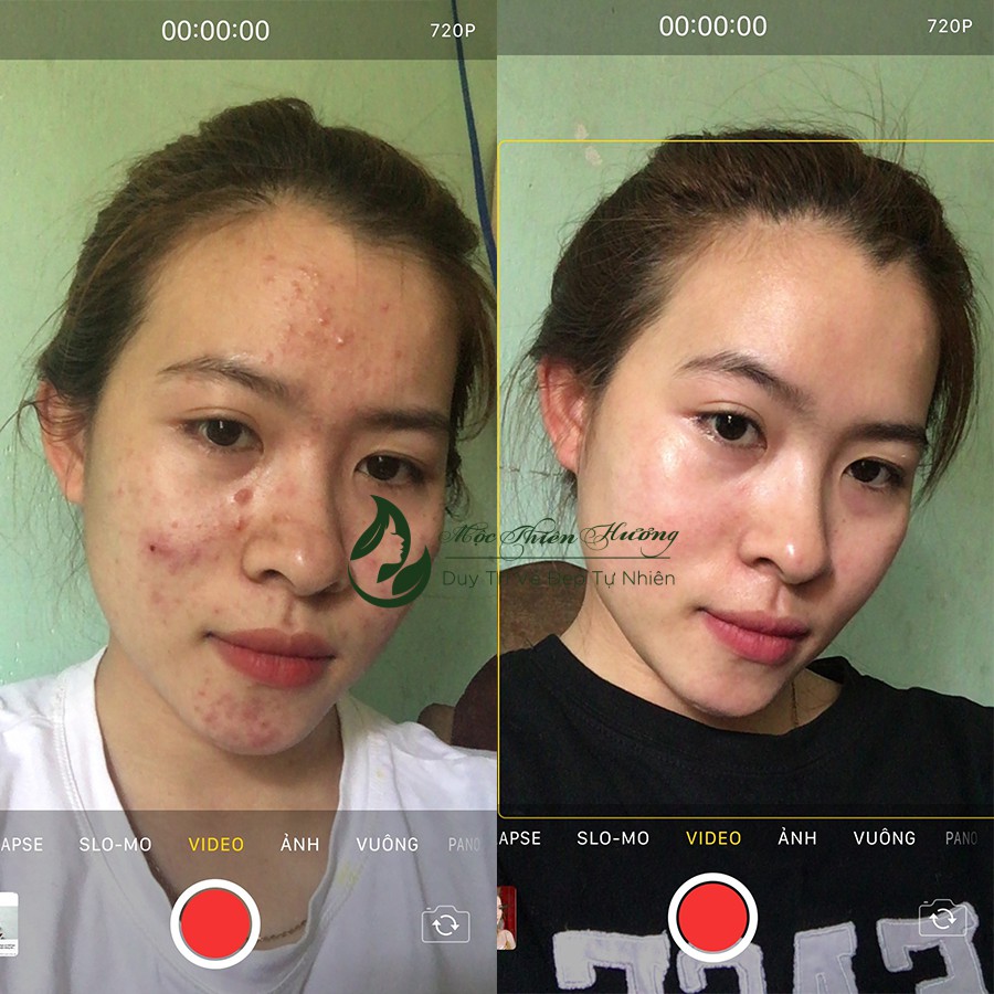 Serum giảm mụn thâm rỗ, sáng da, se khít lỗ chân lông Mộc Thiên Hương | BigBuy360 - bigbuy360.vn