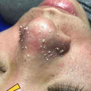 Ủ mụn+ serum se khít