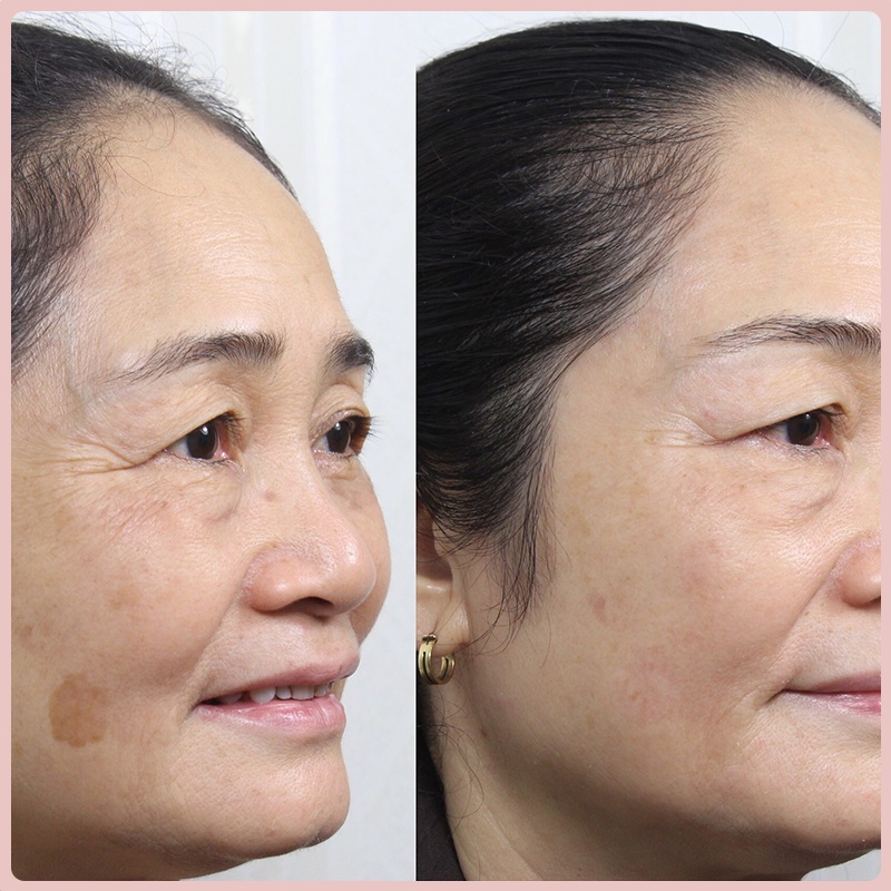 Kem Nám Tàn Nhang Medi White - Medi Melasma - Mờ Nám, Tàn Nhang Hiệu Quả