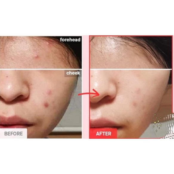 Sữa Rửa Mặt Tạo Bọt Chiết Xuất Rau Má và 0.5% BHA COSRX AC Collection Calming Foam Cleanser 50ml+150ml