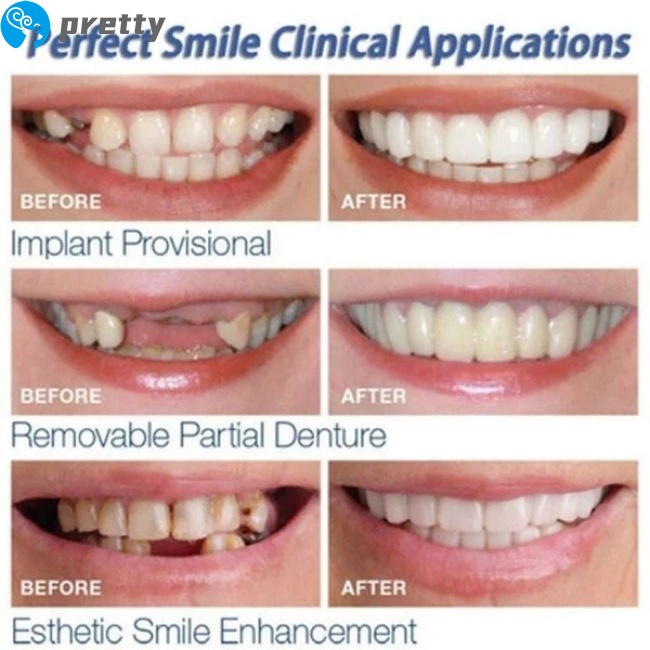 [Hàng mới về] Cặp niềng răng trắng tái sử dụng được tiện lợi