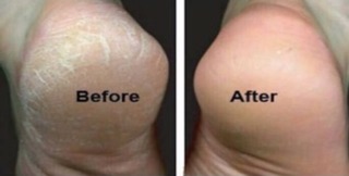 Kem chuối trị nứt gót chân Thái Lan