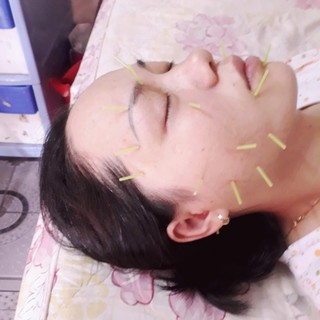KIM CHÂM CỨU THẨM MỸ