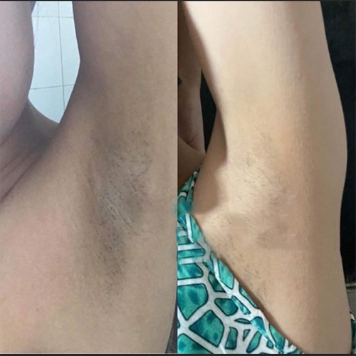 ✅  Serum Nano Aha Khử Thâm Nano Aha - 7 Ngày Hiệu Quả