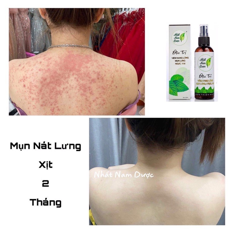 Xịt mụn lưng Hoàng Thiên Sâm 100ml - hoangthiensam