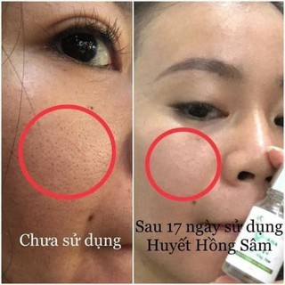 Serum Giảm Mụn Thâm Sẹo Rỗ Huyết Hồng Sâm 10ml Cam Kết Không Sưng Không Đỏ Hiệu Quả Ngay Lọ Đầu Tiên DASATA