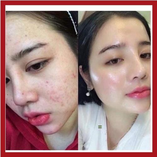 Serum Giảm Mụn CARAMEL ESSENCE Nhật Bản Giảm Ngừa Mụn Xóa Thâm Mờ Sẹo Tái Tạo Dưỡng Da Căng Bóng 5ml
