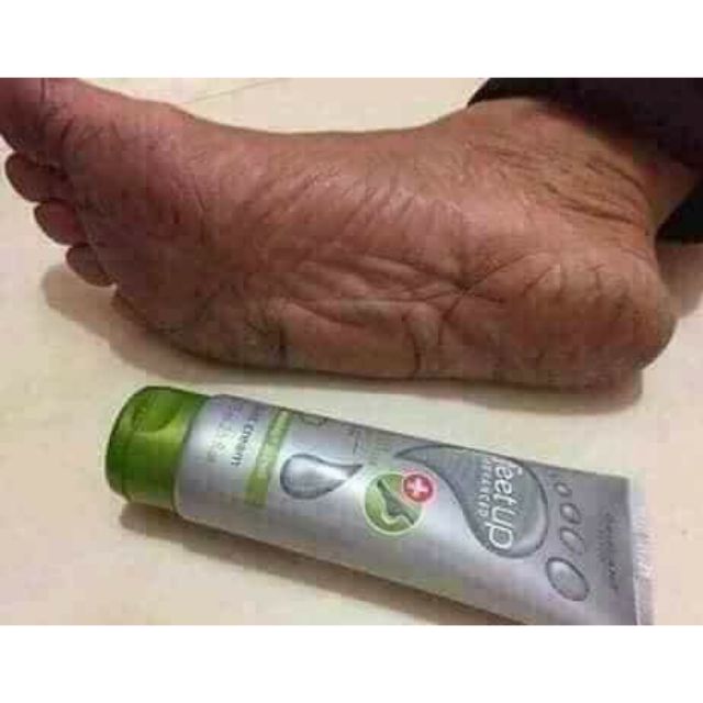 Kem trị nứt gót chân