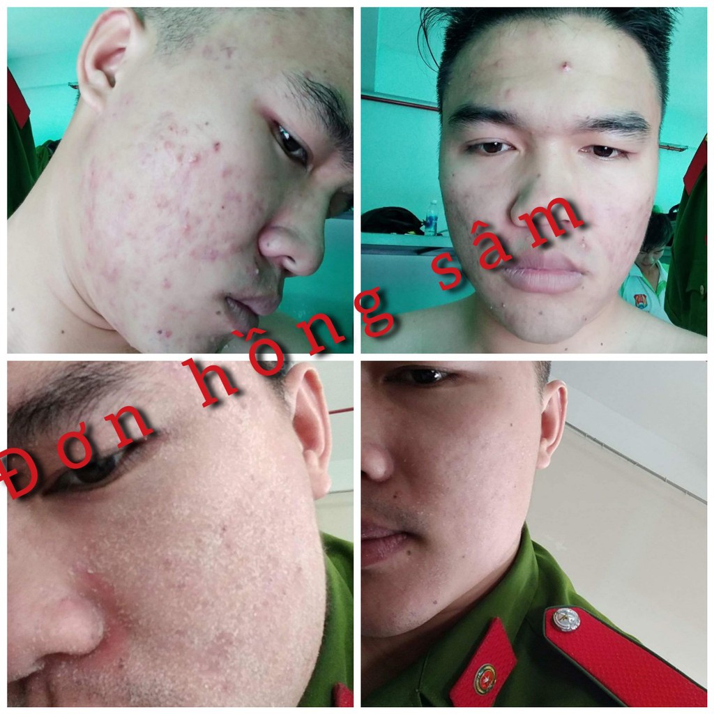 TÁI TẠO DA SERUM MỤN THÂM 100 ML ĐƠN HỒNG SÂM - HẾT MỤN SẠCH THÂM
