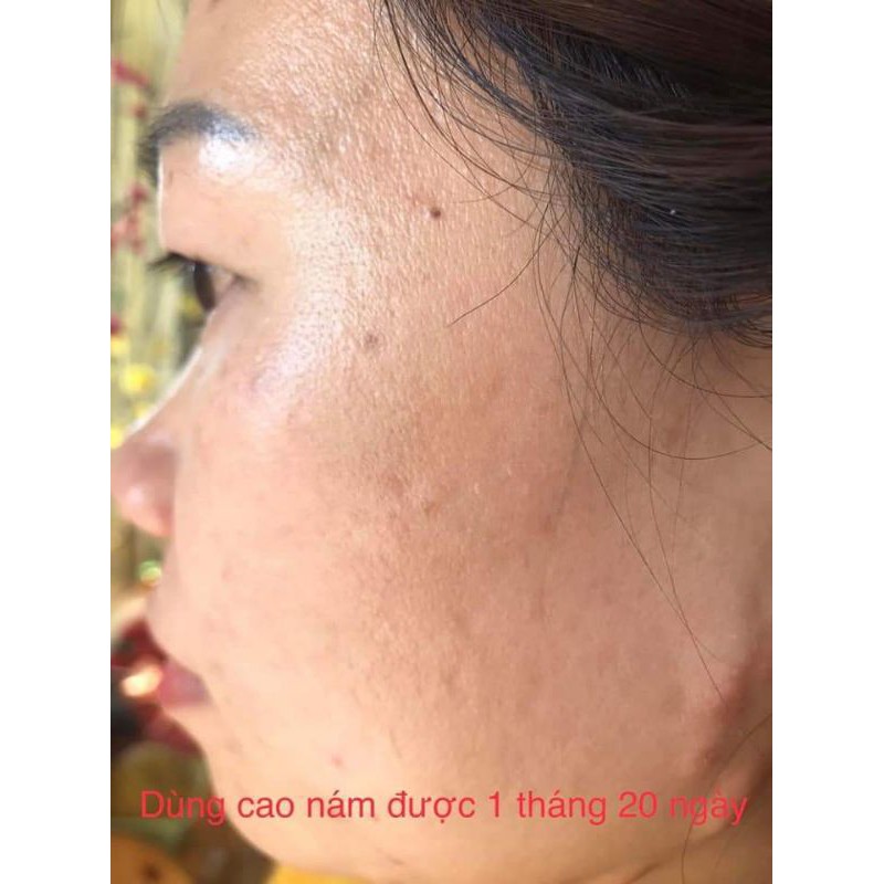 Cao ngừa nám CAO NÁM MAGIC SKIN | BigBuy360 - bigbuy360.vn
