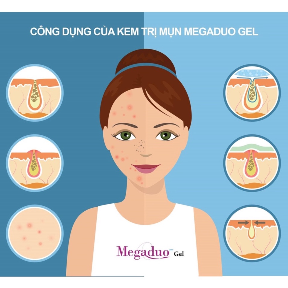 Gel Giảm Mụn Ẩn Và Thâm Gamma Megaduo Gel 15g - Bản thường AHA