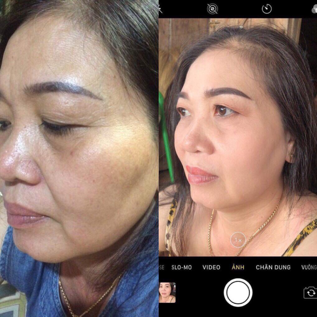 Serum TÁI TẠO THẢO DƯỢC NLS Loại bỏ Mụn - Nám - Tàn Nhang 100ml