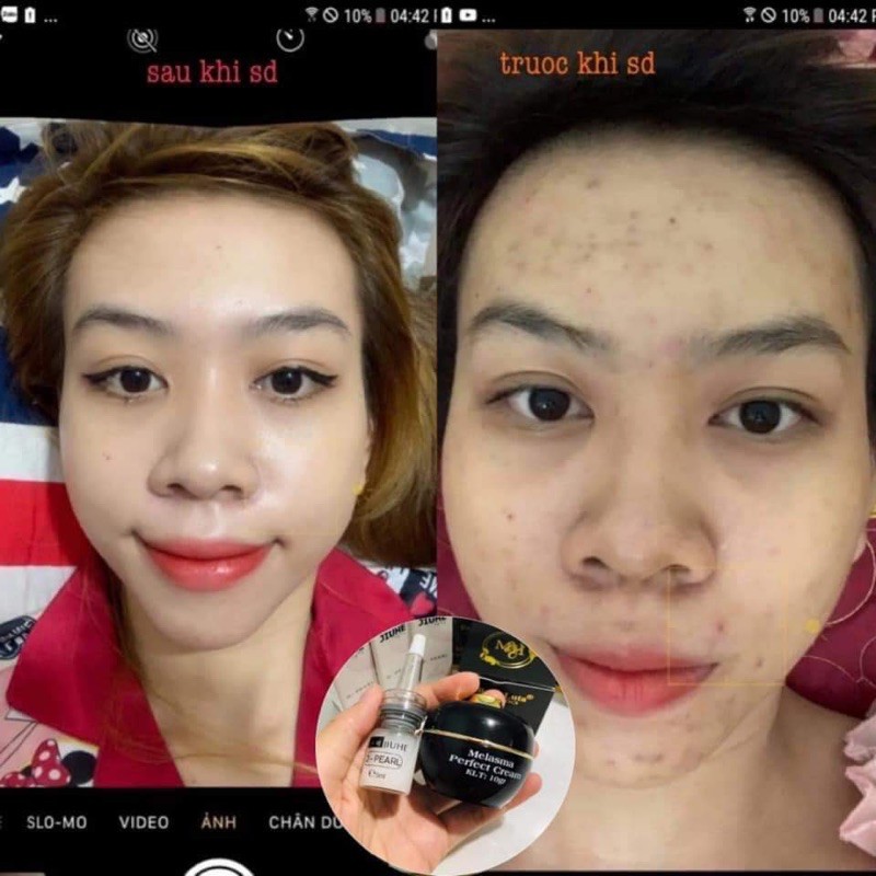 (HÀNG CHÍNH HÃNG 100%) COMBO SERUM JIUHE  THANH TÔ VÀ CAO NÁM BALLA LUTA