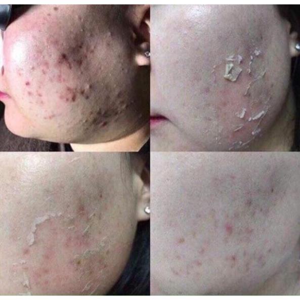 1 Hộp Btox Peel 2 màu thay da sinh học cam kết hàng chính hãng