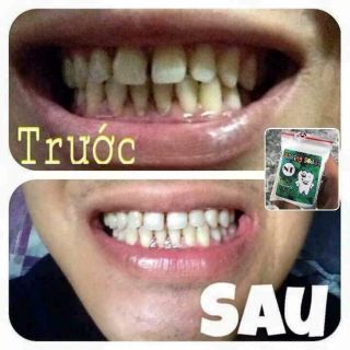 BỘT TRẮNG RĂNG BAKINGSODA 50k