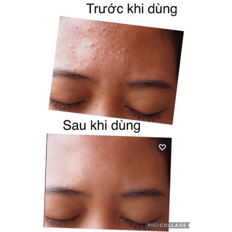 Kem ngừa mụn đẩy nhân mụn, mờ thâm +Dr.Lee Cream | BigBuy360 - bigbuy360.vn