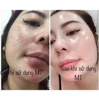 Serum mộc tuyết huyết thanh giảm mụn, dưỡng da trắng sáng mờ thâm