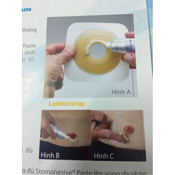 Keo Chống Xì, Làm Đầy, Chống Rò Rỉ Túi Hậu Môn Nhân Tạo Stomahesive Convatec