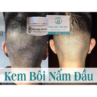 Thuôc bôi Nấm đầu - Nấm da đầu [ Hiệu quả 100% ]