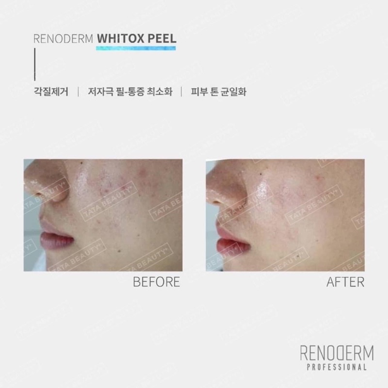 Peel làm trắng da Renoderm 𝐖𝐇𝐈𝐓𝐎𝐗 𝐓𝐑𝐄𝐀𝐓𝐌𝐄𝐍𝐓