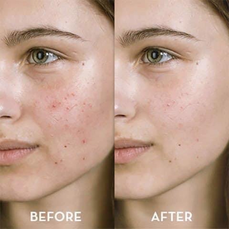 Bộ sản phẩm SVR Sebiaclear có sẵn : sữa rửa mặt, kem dưỡng ...