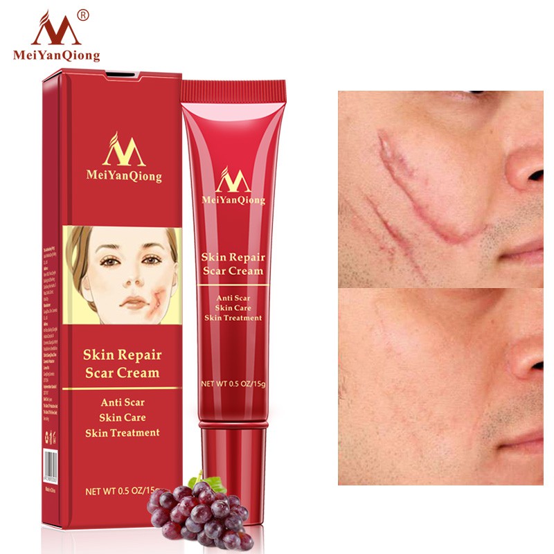 MeiYanQiong Acne Scar Removal Cream Skin Repair Stretch Marks 15ml | BigBuy360 - bigbuy360.vn
