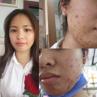 Serum Mộc Beauty Cho Da Mụn Thâm
