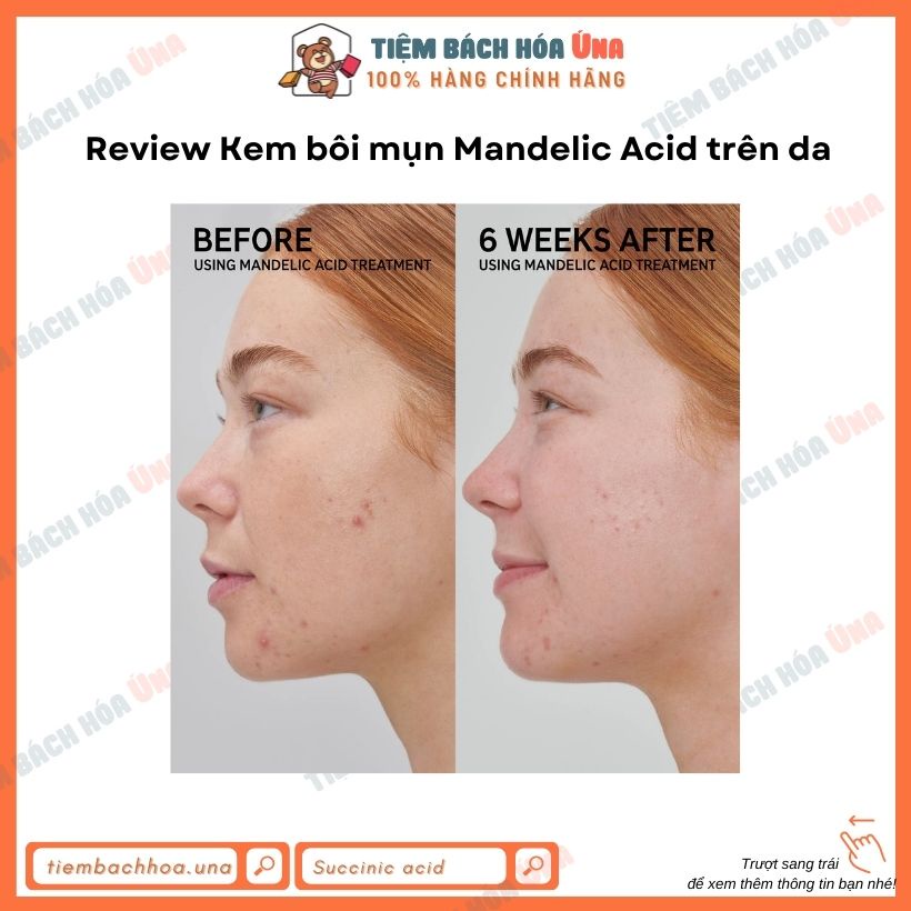 [New] Kem bôi lên mụn The inkey list SUCCINIC ACID và MANDELIC ACID acne treatment 15ml