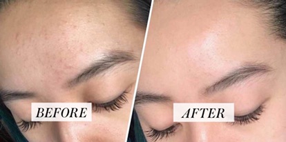 Miếng lau Stridex Maximum