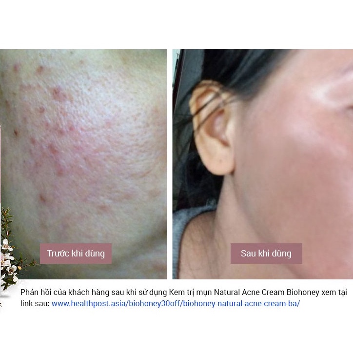 [Hỏa tốc] Kem Mật Ong Biohoney Natural Acne Cream Cho Da Mụn 50g